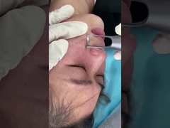 1064nm 532nm সেলুন পিকোসেকেন্ড লেজার মেশিন ত্বকের পিগমেন্টেশন ক্ষত সমস্যার চিকিৎসার জন্য